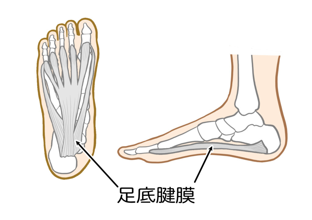 足底筋膜炎